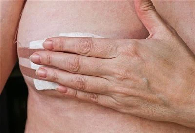 स्तन के अल्ट्रासाउंड-निर्देशित कोर सुई बायोप्सी